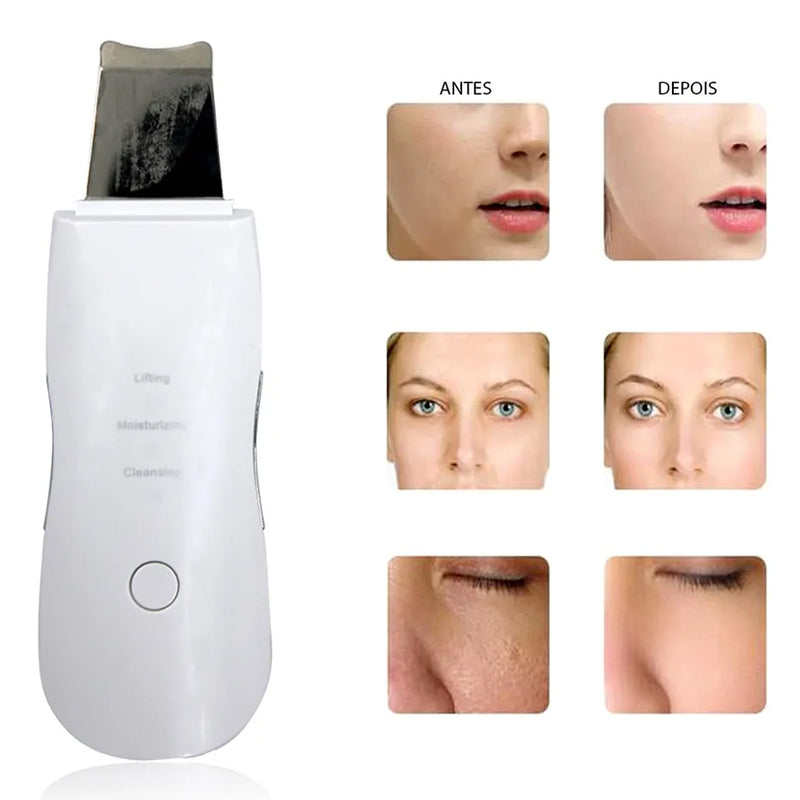 Peeling Ultrassonico Portatil Limpeza De Pele Remove Cravos